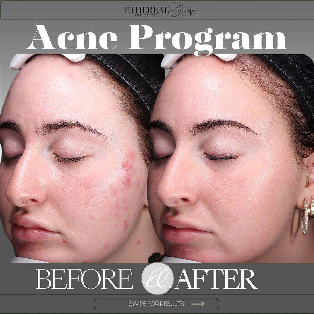 Acne Cover Page Slide #1