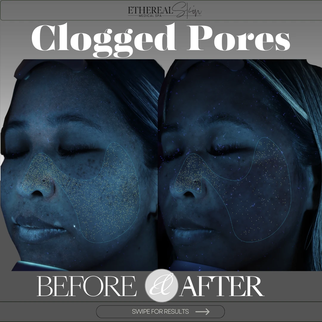 Clogged Pores Before and After etherealskinmedspa a