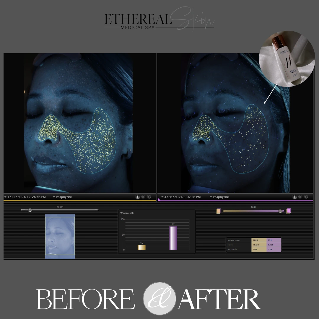 Clogged Pores Before and After etherealskinmedspa b