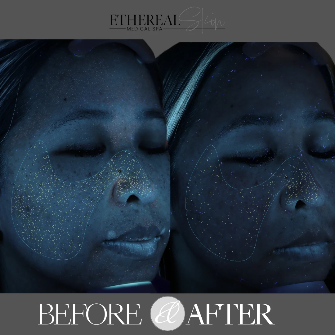 Clogged Pores Before and After etherealskinmedspa c