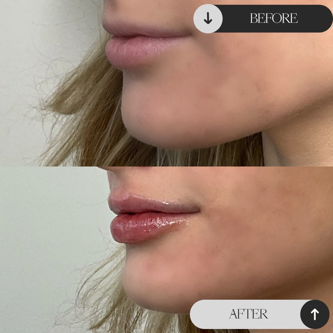 Lip Filler etherealskinmedspa a