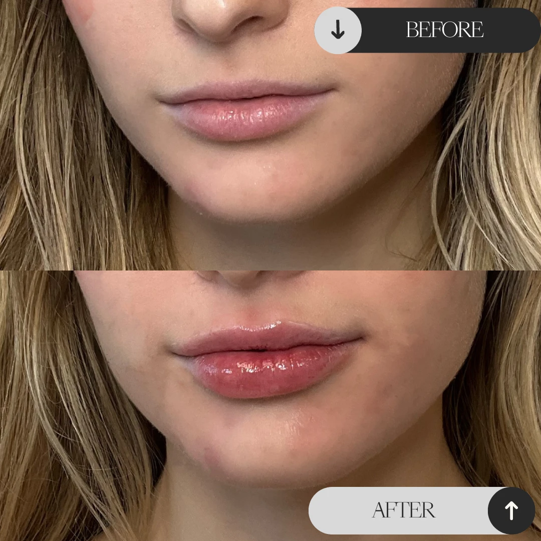 Lip Filler etherealskinmedspa b