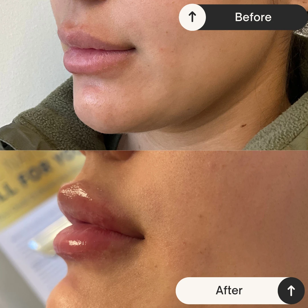 Lip Filler etherealskinmedspa c