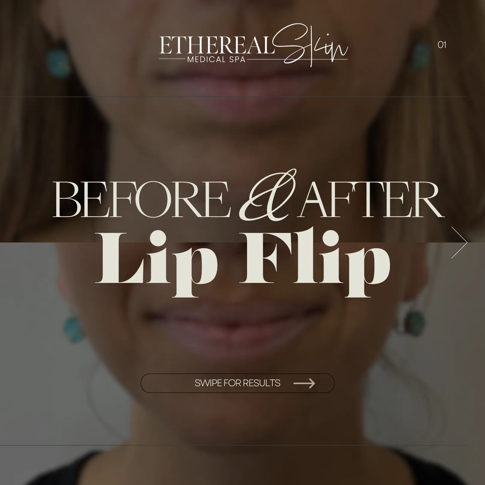 Lip Flip Patient 1