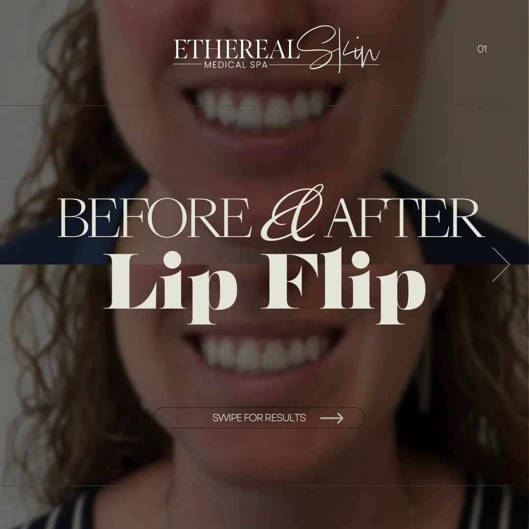 Lip Flip Patient 2