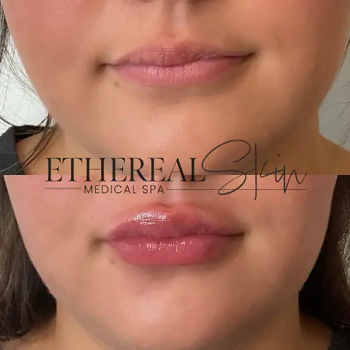 Dermal filler before after 1