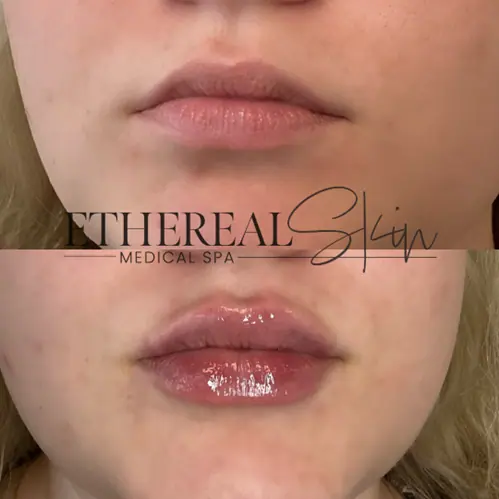 Dermal filler before after 2