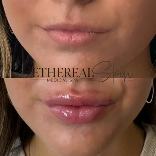 Dermal filler before after 3