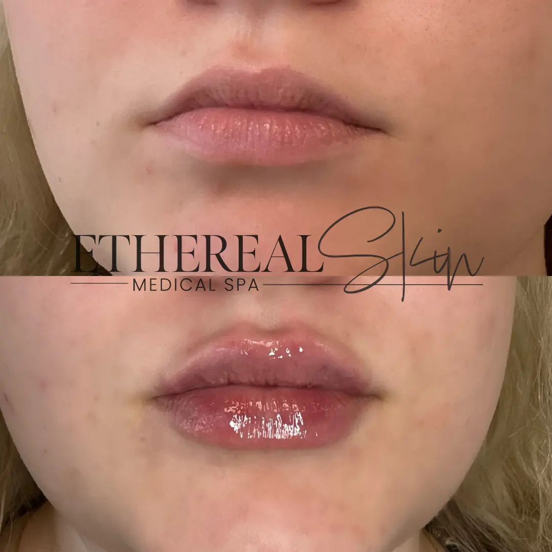 Patient 1 Lip Filler Cover