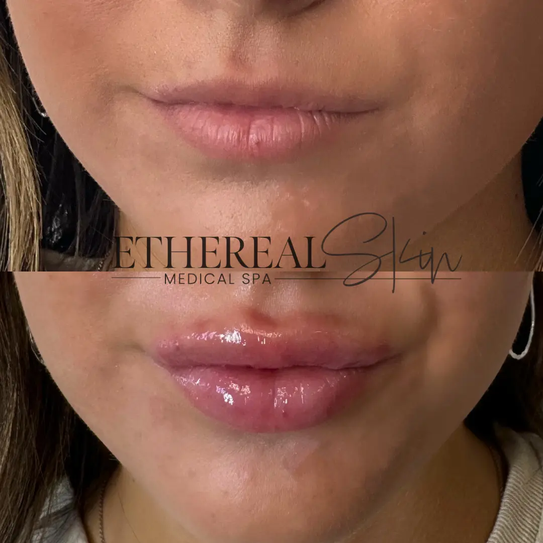 Patient 4 Lip Filler Cover