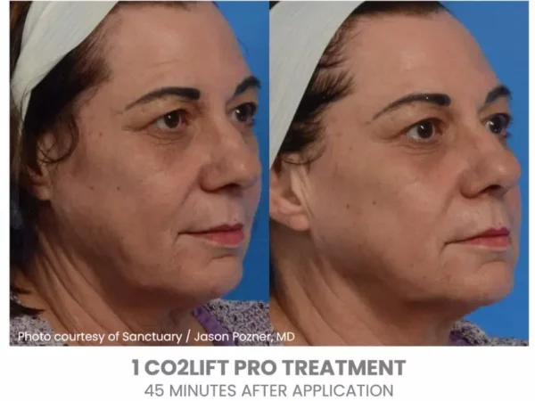 CO2Lift Pro Carboxy Gel Treatment