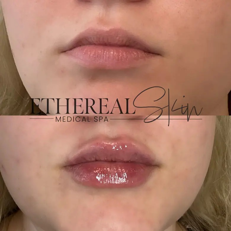 Dermal Fillers Before & Afters