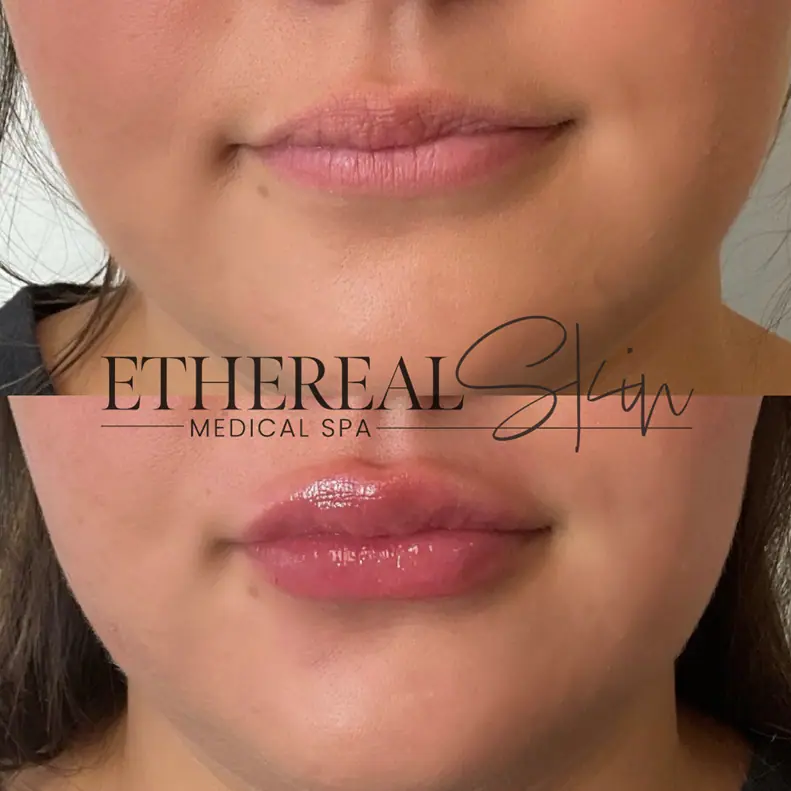 Dermal Fillers Before & After