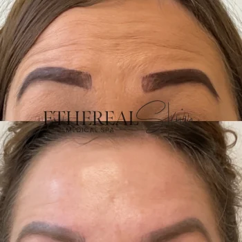 Botox 2 Letybo5.14 (2)