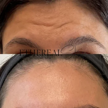 Botox 2 Letybo5.14