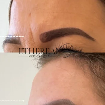Botox 2 Letybo5.14 second slide