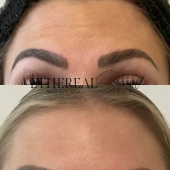Botox 5.14