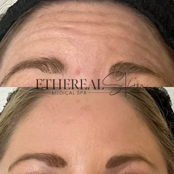 Botox B&A