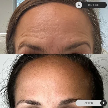 Botox Before and After
