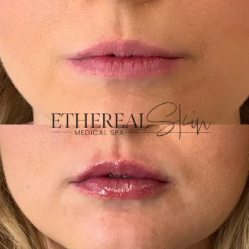 Lips B&A