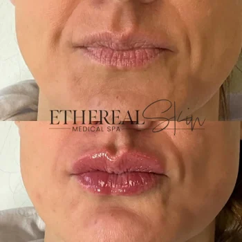 Lips B&A