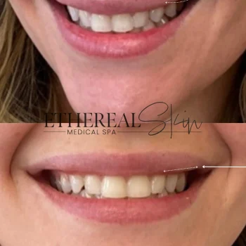 Lip Filler B&A