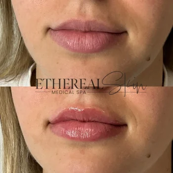 Lips B&A 2