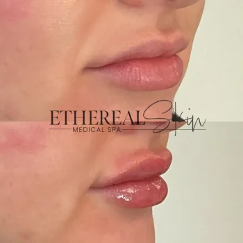 Lips B&A