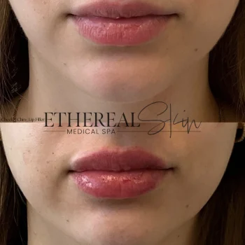 Lip B&A 4