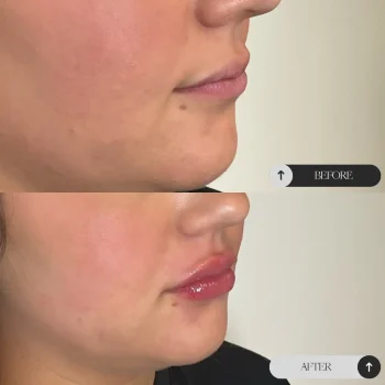 Lip Filler Madden Page Op2