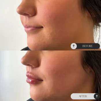 Lip Filler Madden Page Op3