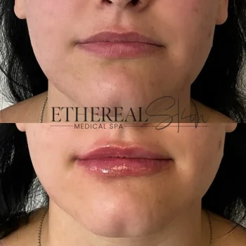 Lip Filler Patient 5
