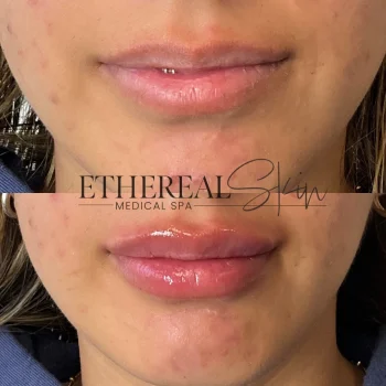 Lip Filler in Canonsburg, PA