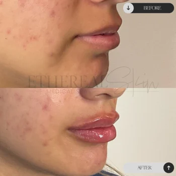 Lip Filler_1273