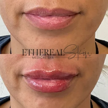Lips B&A 1 5.14