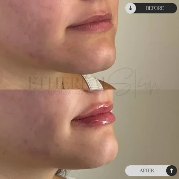 Patient 5 Lip Filler pg 2