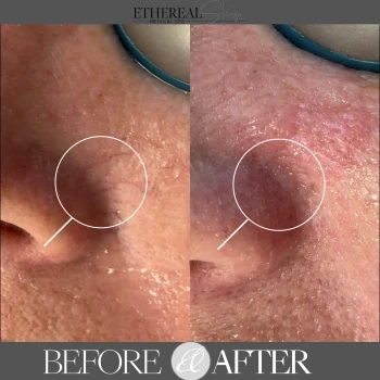 Skin laser Slide 2